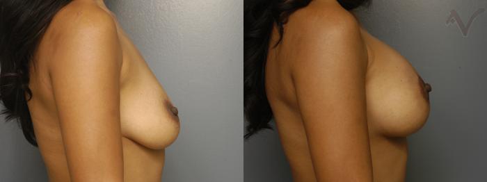 Before & After Breast Augmentation with Lift Case 114 Right Side View in Los Angeles, CA