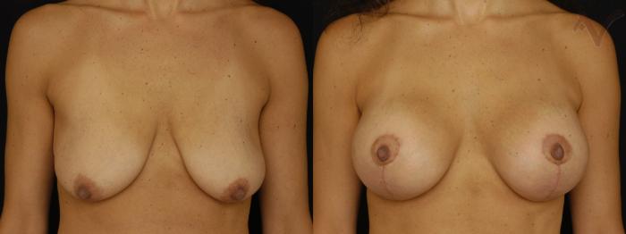 Before & After Breast Augmentation with Lift Case 115 Front View in Los Angeles, CA