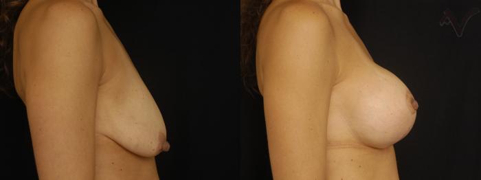Before & After Breast Augmentation with Lift Case 115 Right Side View in Los Angeles, CA