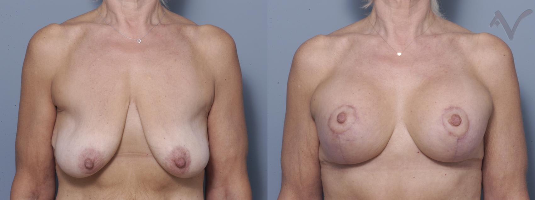 Before & After Breast Augmentation with Lift Case 116 Front View in Los Angeles, CA