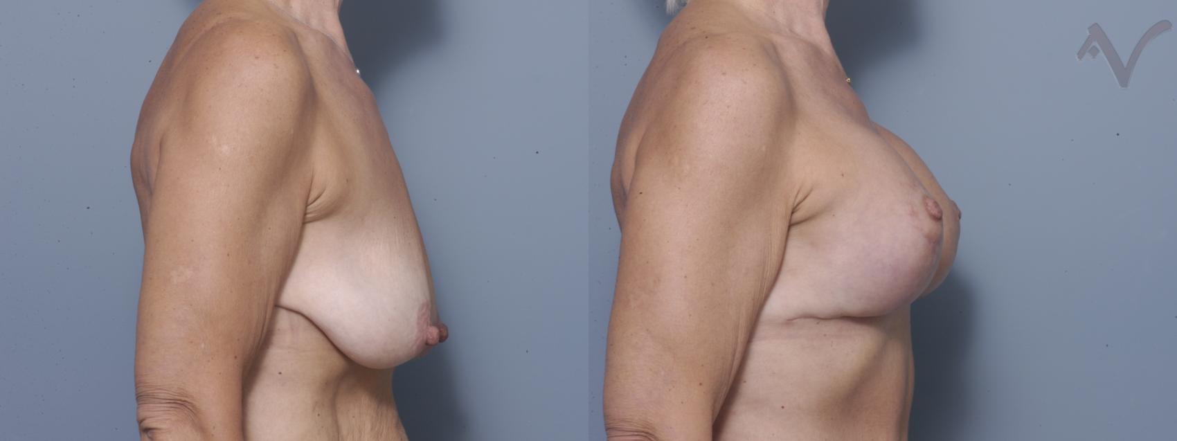 Before & After Breast Augmentation with Lift Case 116 Right Side View in Los Angeles, CA