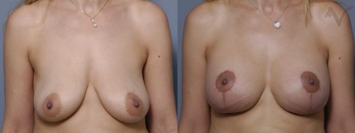 Before & After Breast Augmentation with Lift Case 117 Front View in Los Angeles, CA