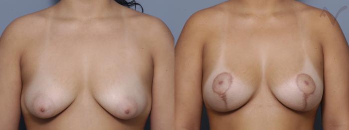 Before & After Breast Augmentation with Lift Case 118 Front View in Los Angeles, CA