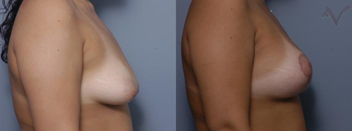Before & After Breast Augmentation with Lift Case 118 Right Side View in Los Angeles, CA