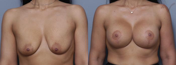 Before & After Breast Augmentation with Lift Case 119 Front View in Los Angeles, CA