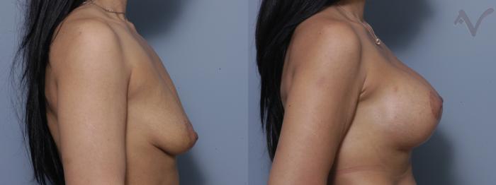 Before & After Breast Augmentation with Lift Case 119 Right Side View in Los Angeles, CA