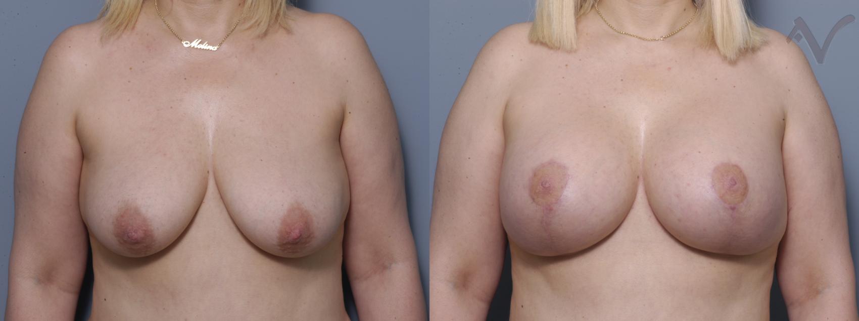 Before & After Breast Augmentation with Lift Case 120 Front View in Los Angeles, CA