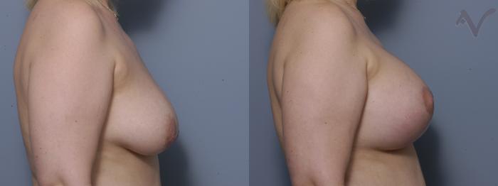 Before & After Breast Augmentation with Lift Case 120 Right Side View in Los Angeles, CA