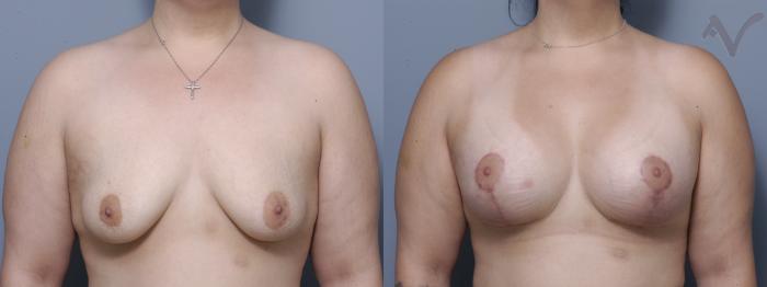 Before & After Breast Augmentation with Lift Case 165 Front View in Los Angeles, CA