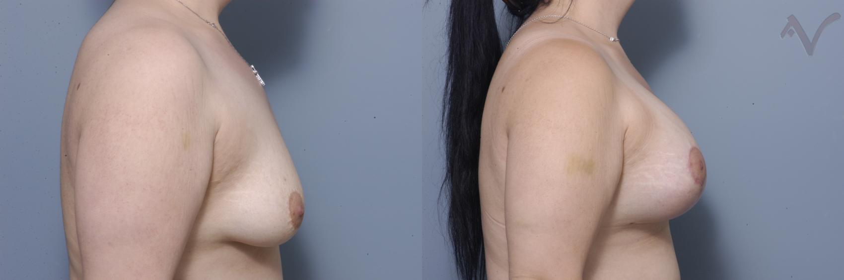 Before & After Breast Augmentation with Lift Case 165 Right Side View in Los Angeles, CA