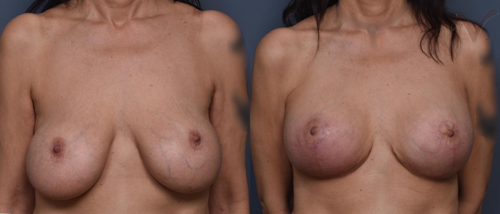 Before & After Breast Augmentation with Lift Case 451 Front View in Los Angeles, CA