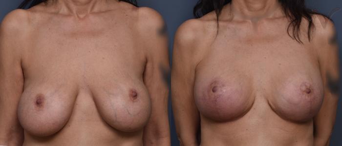 Before & After Breast Augmentation with Lift Case 451 Front View in Los Angeles, CA