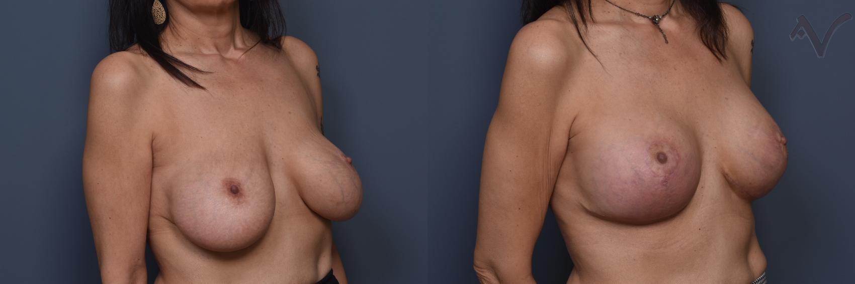 Before & After Breast Augmentation with Lift Case 451 Right Oblique View in Los Angeles, CA