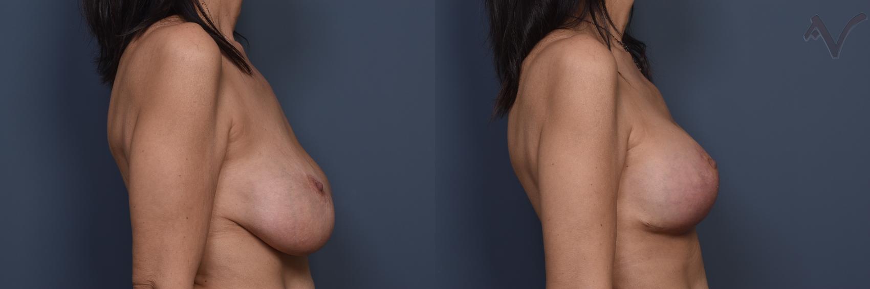 Before & After Breast Augmentation with Lift Case 451 Right Side View in Los Angeles, CA