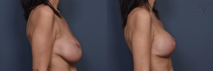Before & After Breast Augmentation with Lift Case 451 Right Side View in Los Angeles, CA