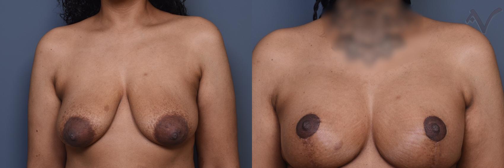 Before & After Breast Augmentation with Lift Case 453 Front View in Los Angeles, CA