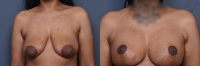 Before & After Breast Augmentation with Lift Case 453 Front View in Los Angeles, CA