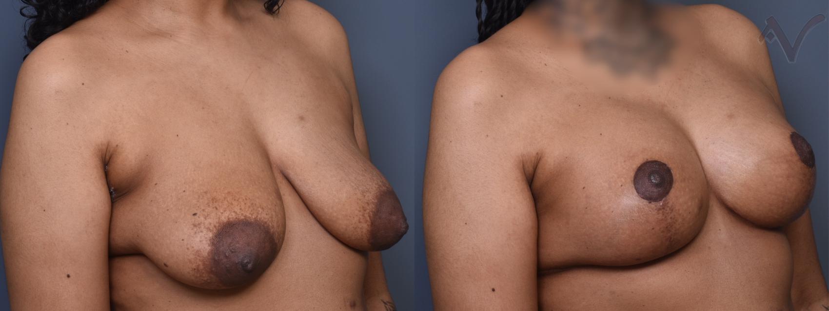 Before & After Breast Augmentation with Lift Case 453 Right Oblique View in Los Angeles, CA