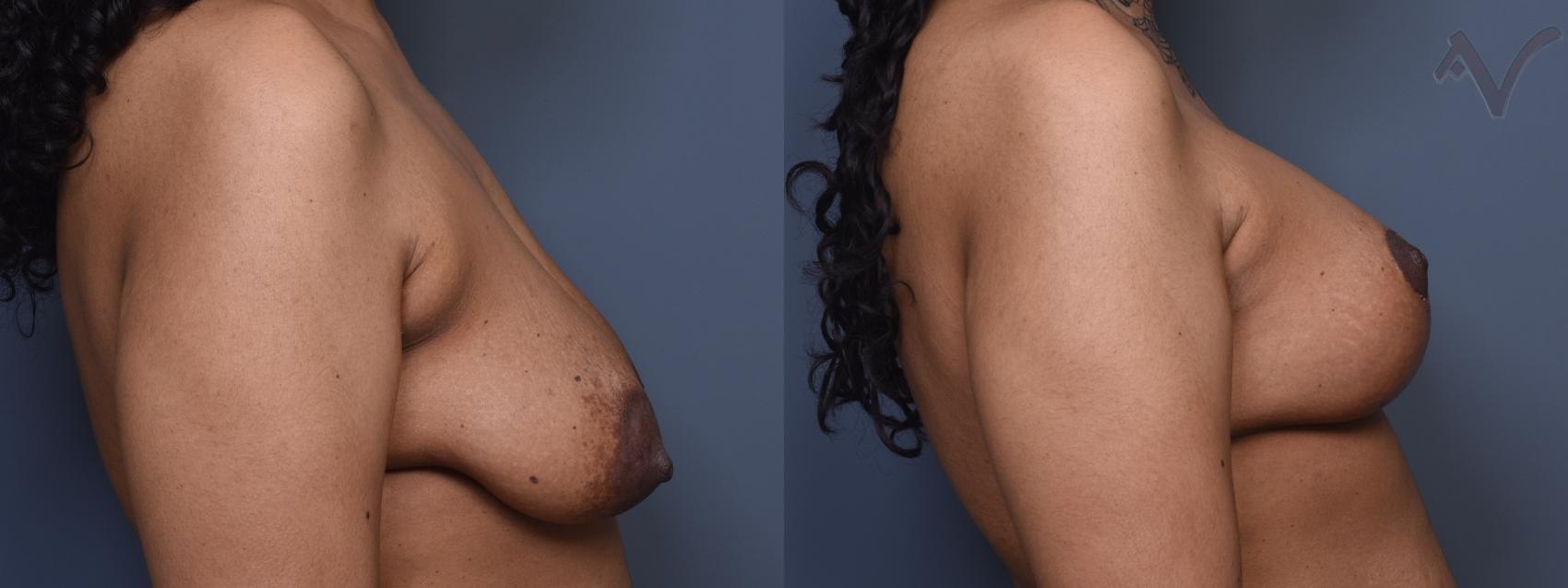 Before & After Breast Augmentation with Lift Case 453 Right Side View in Los Angeles, CA
