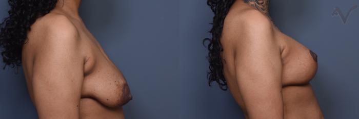 Before & After Breast Augmentation with Lift Case 453 Right Side View in Los Angeles, CA
