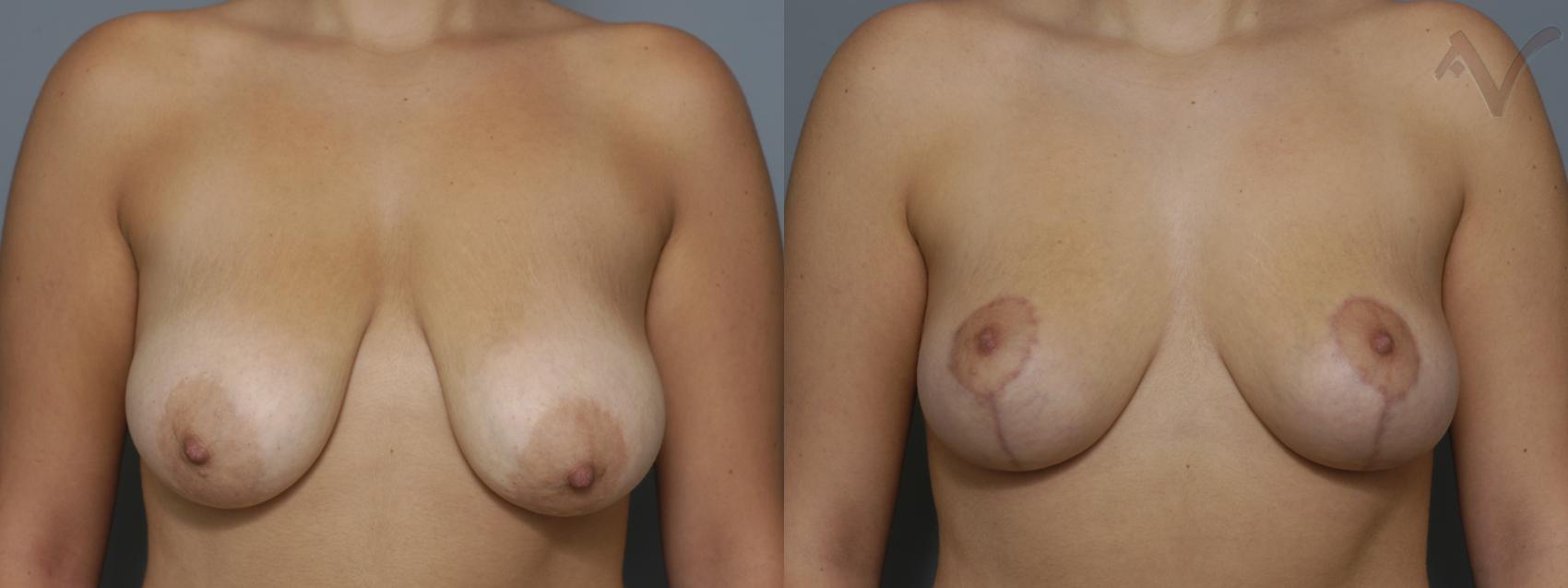 Before & After Breast Lift Case 166 Front View in Burbank, CA
