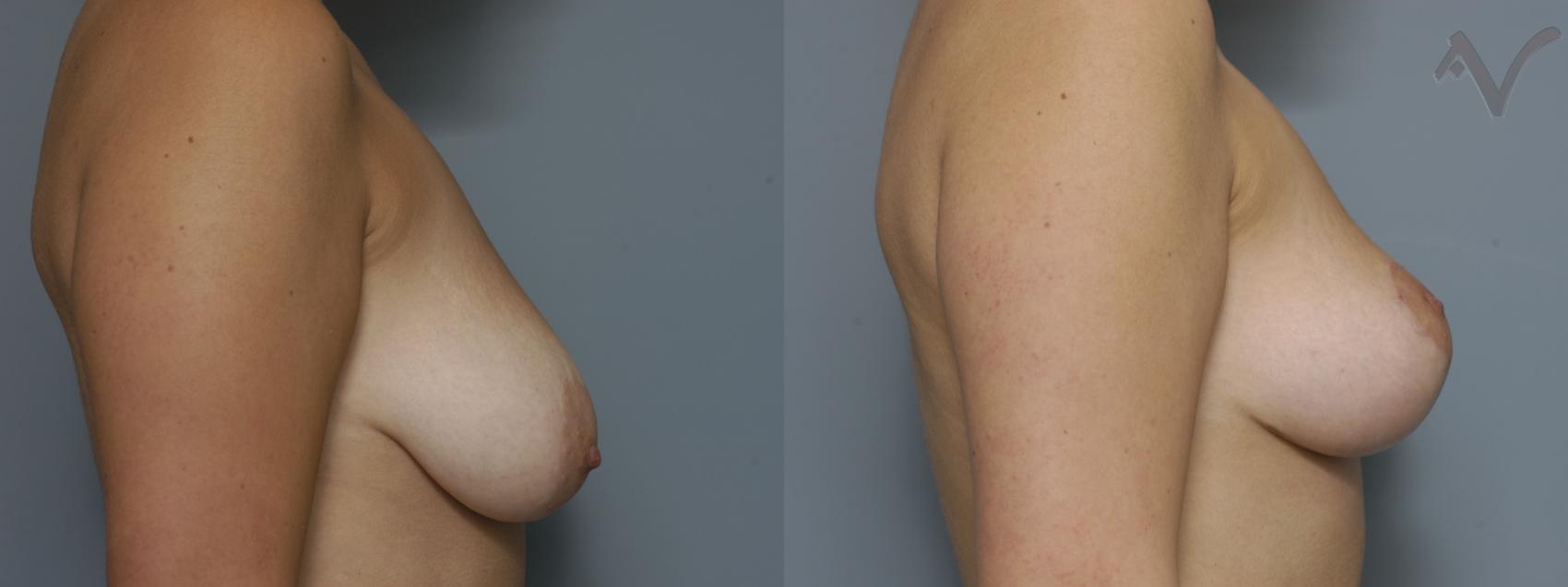 Before & After Breast Lift Case 166 Right Side View in Los Angeles, CA