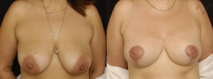 Before & After Breast Lift Case 168 Front View in Los Angeles, CA