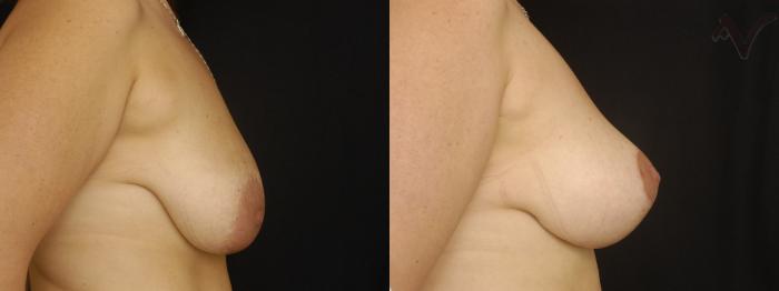 Before & After Breast Lift Case 168 Right Side View in Los Angeles, CA