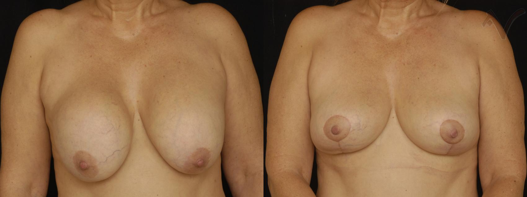 Before & After Breast Lift Case 169 Front View in Burbank, CA