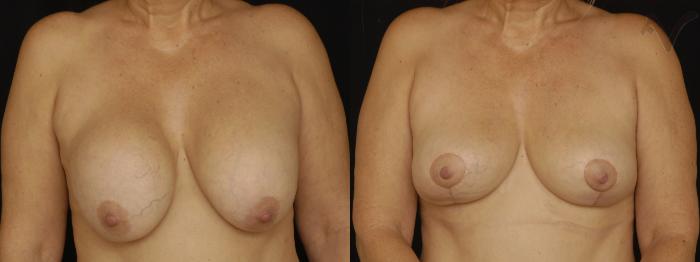 Before & After Breast Lift Case 169 Front View in Los Angeles, CA