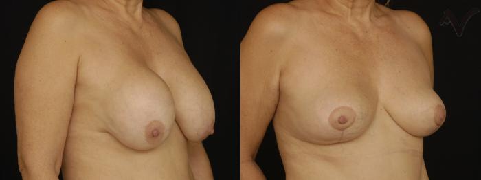 Before & After Breast Lift Case 169 Right Oblique View in Los Angeles, CA
