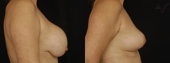 Before & After Breast Lift Case 169 Right Side View in Los Angeles, CA