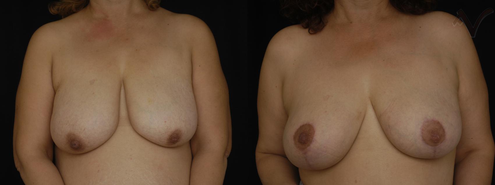 Before & After Breast Lift Case 171 Front View in Los Angeles, CA