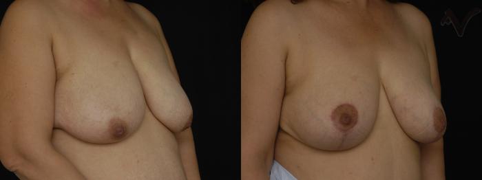 Before & After Breast Lift Case 171 Right Oblique View in Los Angeles, CA