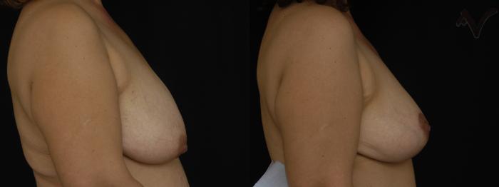 Before & After Breast Lift Case 171 Right Side View in Los Angeles, CA