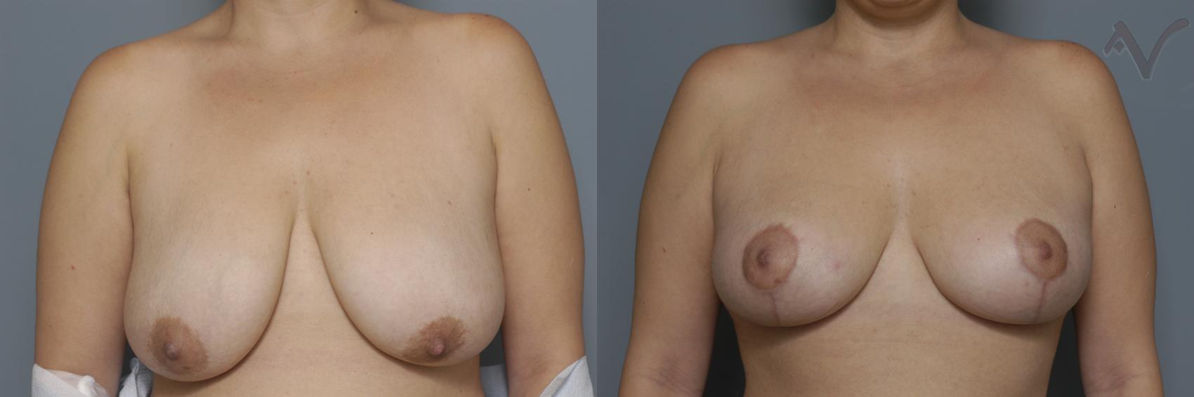 Before & After Breast Lift Case 172 Front View in Burbank, CA