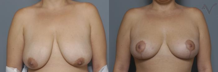 Before & After Breast Lift Case 172 Front View in Los Angeles, CA