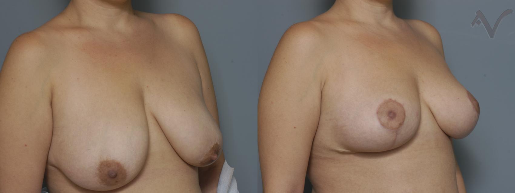 Before & After Breast Lift Case 172 Right Oblique View in Burbank, CA