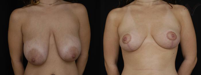 Before & After Breast Lift Case 173 Front View in Los Angeles, CA