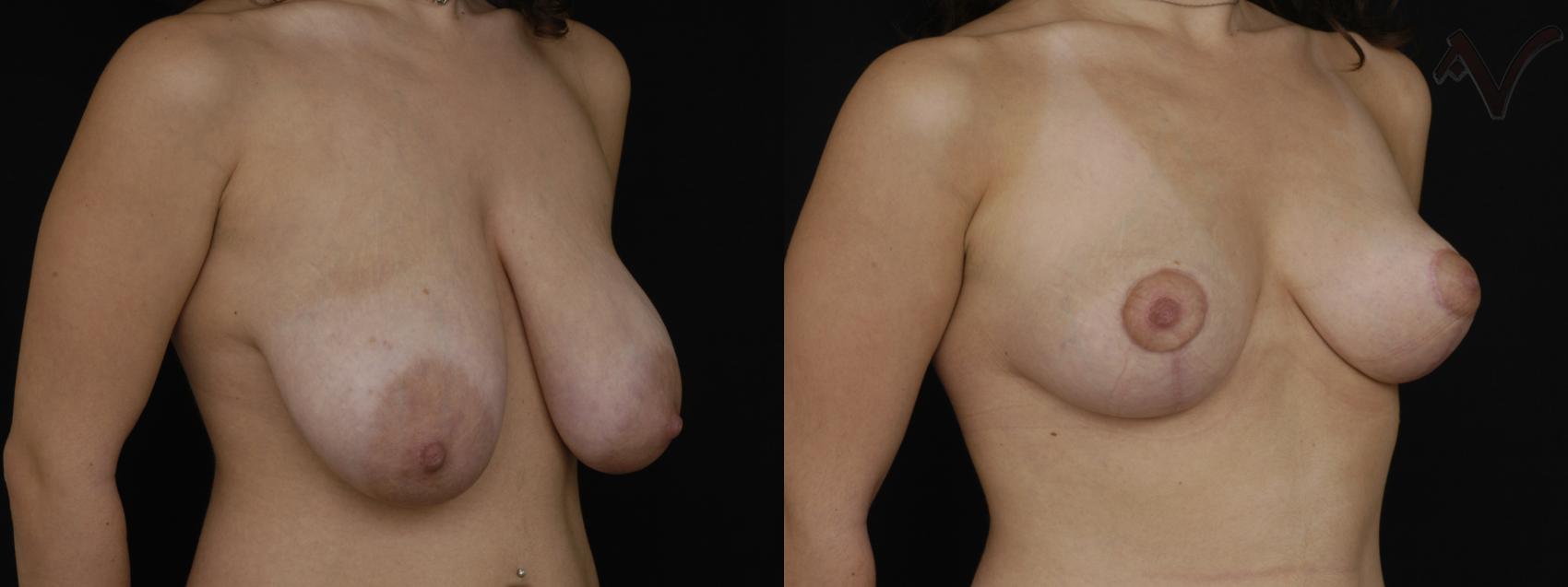 Before & After Breast Lift Case 173 Right Oblique View in Burbank, CA
