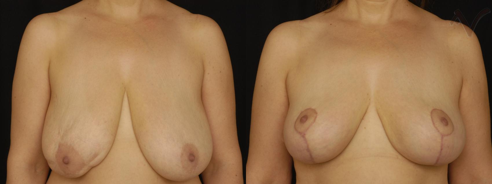 Before & After Breast Lift Case 174 Front View in Burbank, CA