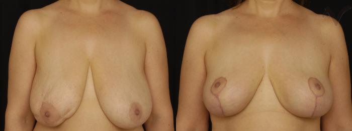 Before & After Breast Lift Case 174 Front View in Los Angeles, CA