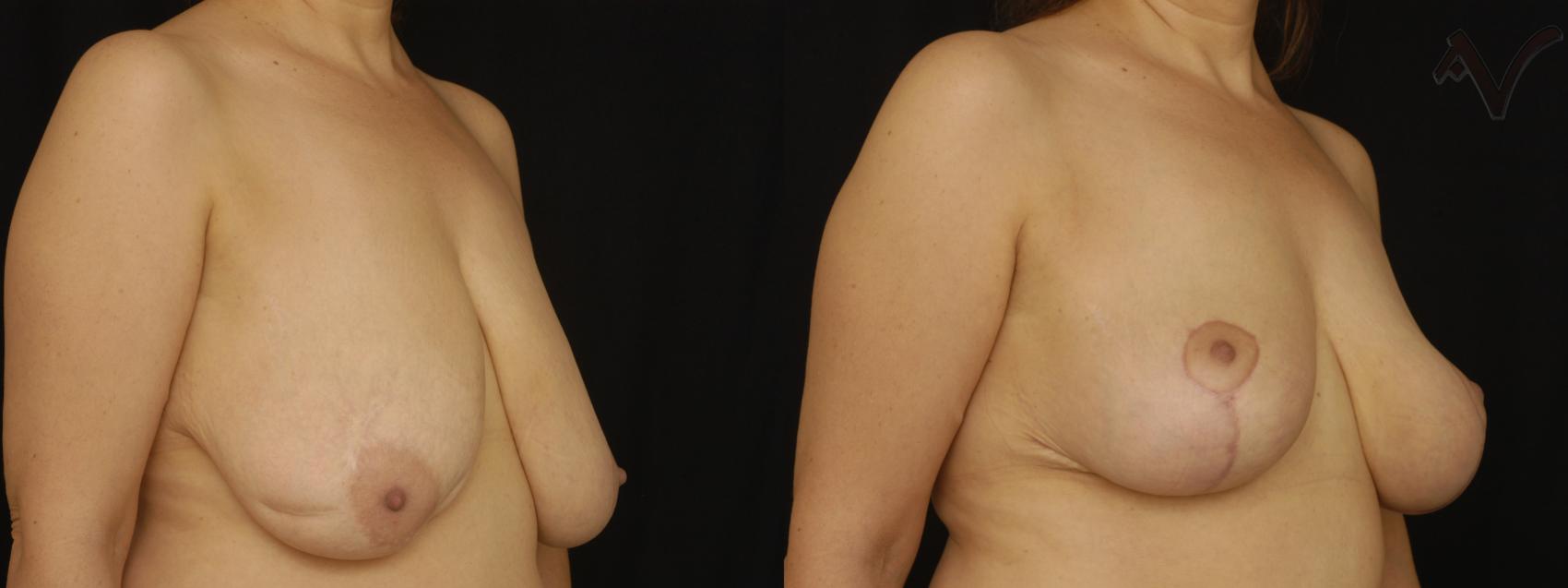 Before & After Breast Lift Case 174 Right Oblique View in Burbank, CA