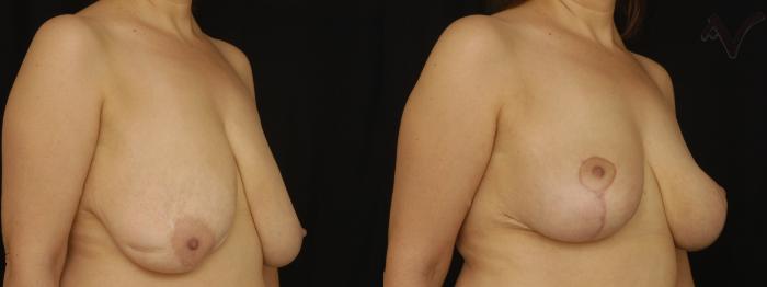 Before & After Breast Lift Case 174 Right Oblique View in Los Angeles, CA