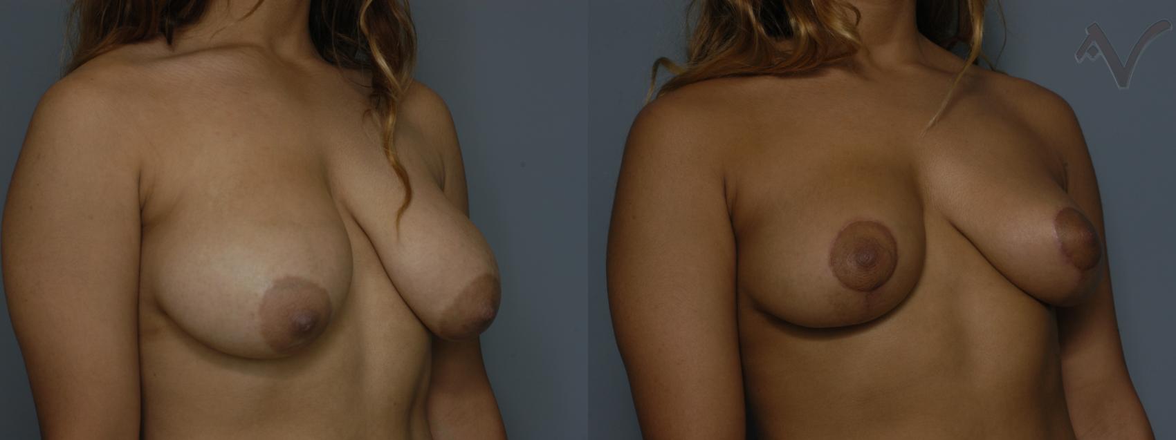 Before & After Breast Lift Case 177 Right Oblique View in Burbank, CA