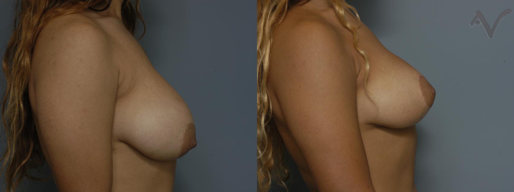 Before & After Breast Reduction Case 177 Right Side View in Burbank, CA