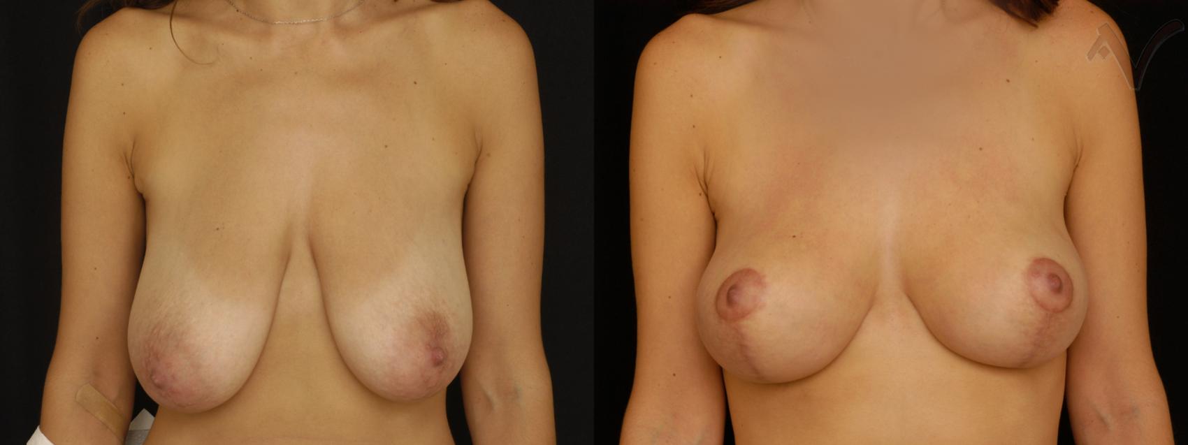 Before & After Breast Lift Case 178 Front View in Burbank, CA