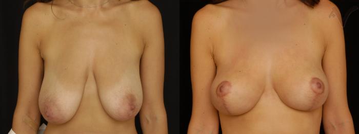 Before & After Breast Lift Case 178 Front View in Los Angeles, CA