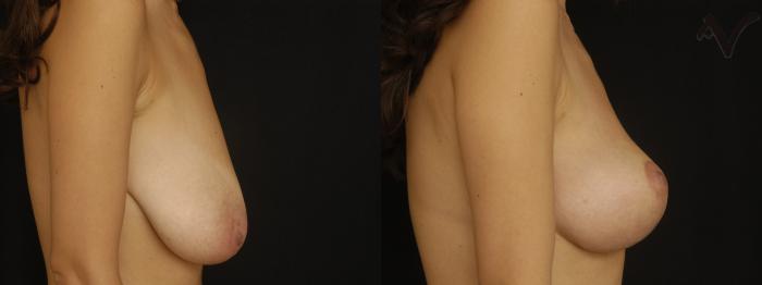 Before & After Breast Lift Case 178 Right Side View in Los Angeles, CA