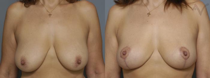 Before & After Breast Lift Case 179 Front View in Los Angeles, CA